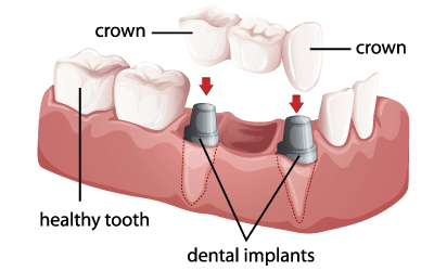 multi teeth dental implant